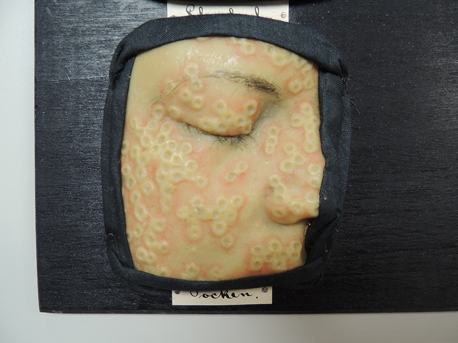 Wax molds depicting chickenpox by Theodor Henning (1922)