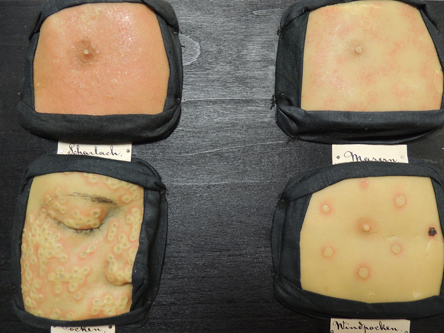 Wax molds depicting chickenpox by Theodor Henning (1922)