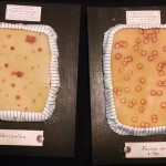 Wax molds depicting chickenpox by Theodor Henning