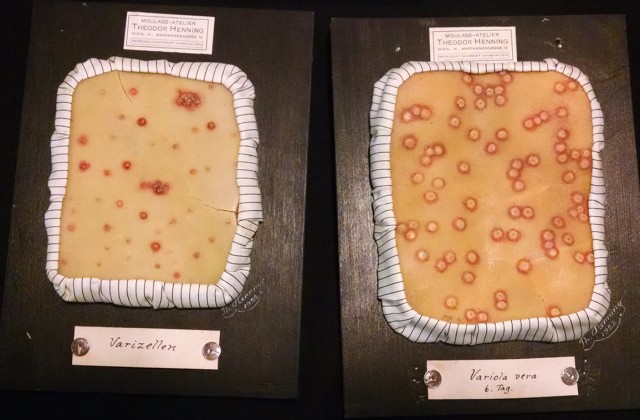 Wax molds depicting chickenpox by Theodor Henning
